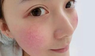 脸上红血丝怎么回事 脸上红血丝怎么回事